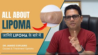 All About Lipoma  What are the causes and treatment options for Lipma  Lipoma Surgery in Delhi [upl. by Michel]