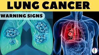 Lung Cancer Warning Signs II Lung Cancer Symptoms [upl. by Ahsilif]