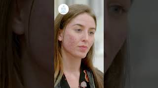 Dermabrasion in Turkey skincare acnescars [upl. by Anneres]