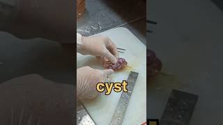 Cyst from the fallopian tube [upl. by Archibold]