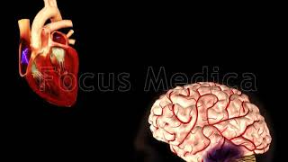 Chronic atrial fibrillation  Animated Atlas of Atrial Fibrillation [upl. by Anayd647]