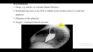 L66 Physiology  Achalasia [upl. by Artinahs455]