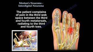 Mortons Neuroma  Interdigital Neuroma  Everything You Need To Know  Dr Nabil Ebraheim [upl. by Sterrett]