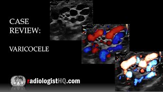 Ultrasound of Varicocele [upl. by Regor]