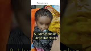 Baby with Talipes Equinoverus Hydrocephalus neonate baby [upl. by Crist]