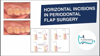 BASIC INCISIONS HORIZONTAL INCISIONS IN PERIODONTAL FLAP SURGERY DR ANKITA KOTECHA [upl. by Geddes]