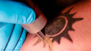 How Laser Tattoo Removal Works  Smarter Every Day 123 [upl. by Neelrihs]