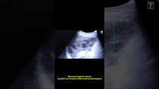 Splenic hydatid cyst or lymphangioma [upl. by Enerod922]