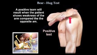 Subscapularis tendon tear Bear Hug Test   Everything You Need To Know  Dr Nabil Ebraheim [upl. by Gaskill602]