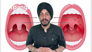 Herpangina explained by Dr Arshdeep Singh [upl. by Macy]