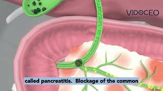 Choledocholithiasis explained [upl. by Ecirtak]