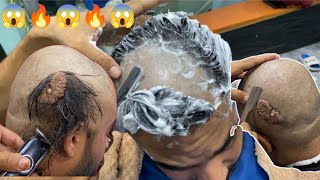 MUST WATCH 😱  Dandruff makes big Tumor Head shaved [upl. by Nomor]