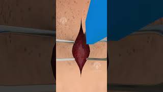 How a Tracheotomy Tube Can Save Lives Hindi shorts viralvideo  Creativelearning3d [upl. by Zenobia]