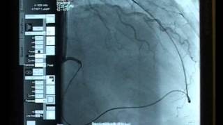 Case 02 Antegrade and Retrograde approach Bilateral Sheathless Radial access [upl. by Bellina]