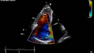 HUGE TRICUSPID REGURGITATION [upl. by Brennen]