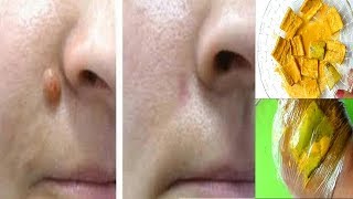 Just 1 Single Night Remove Skin Tag Mole And Wart Fast With Skin Tag Treatment [upl. by Aseuqram]