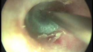 Fluid in middle Ear Serous Otitis Grommet insertionwmv [upl. by Ardnasela]