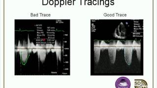 Optimizing Your Echo Images amp Doppler Evaluations webcast [upl. by Chenee790]