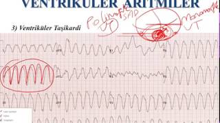 EKG  Ventriküler Aritmiler ECG  Ventricular Arrhythmias [upl. by Ahsiakal]