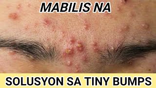 PAANO MAALIS ANG TINY BUMPS OR BUTLIGBUTLIG SA MUKHA [upl. by Nance700]