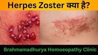 Herpes Zoster क्या है  Shingles का Homeopathic Treatment  दाद हर्पीस ज़ोस्टर का समाधान [upl. by Neelyak145]