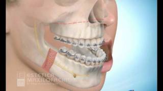 Cirugia maxilofacial  Avance del maxilar superior con retroceso mandibular [upl. by Jerman]