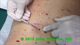 Multiple Dilated Pores  Blackhead Extractor [upl. by Anerok986]