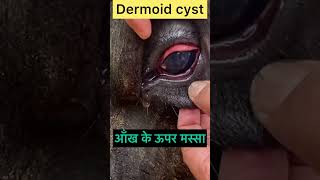 Dermoid cyst l Dr umar khan [upl. by Schacker]