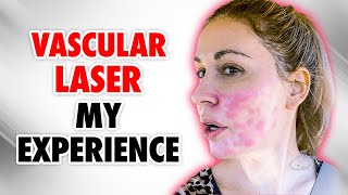 My FIRST time Trying the VASCULAR LASER Here’s What I Learned [upl. by Allecsirp]