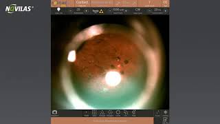 Navilas® Laser Peripheral Iridotomy Treatment [upl. by Nolyaw]