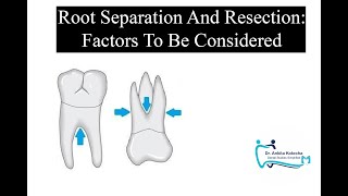 ROOT SEPARATION AND RESECTION Factors to be considered treatment of furcation involvement [upl. by Nilknarf]