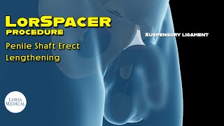 Suspensory Ligament Release procedure How its done [upl. by Elehcir101]