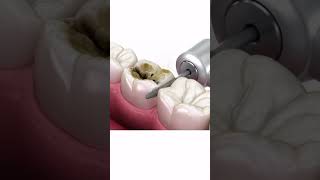 Corona dental dental viral parati fyp dentistry odonto coronadental caries viralshort [upl. by Lzeil]