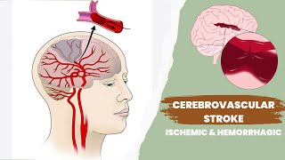 Cerebrovascular accident or stroke  Ischemic and hemorrhagic [upl. by Charley943]