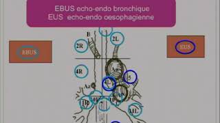 Place de la chirurgie dans les cancers bronchiques [upl. by Melvena]