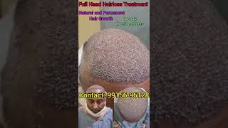 10000 grafts 7 grade baldness cover full head with density hair hairstylist hairtransformation [upl. by Naraa]