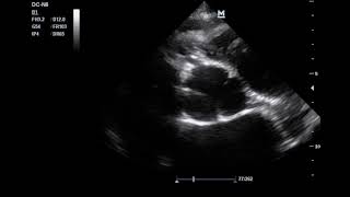 Aortic dissection  Dissecção aórtica [upl. by Eshelman576]