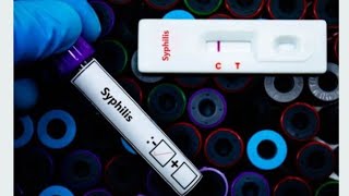 How To Use Syphilis Rapid Diagnostic Test  VDRL Test [upl. by Ayotl]