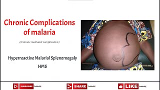 Hyperreactive Malarial Splenomegaly HMS [upl. by Calisa]