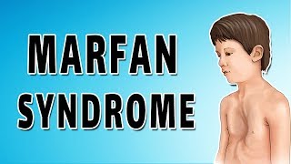 Marfan Syndrome [upl. by Marijo]