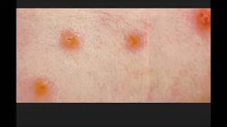 Chiggers simple facts You should know [upl. by Einhpets]