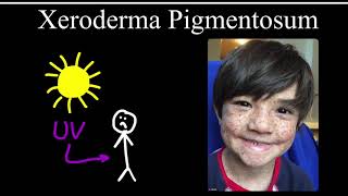 Xeroderma Pigmentosum [upl. by Prichard]