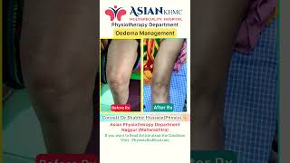 Oedema physiotherapy Treatment physiotherapy edema swelling [upl. by Kcim990]