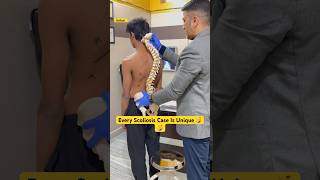 Kyphoscoliosis case treatment by DrRavi kyphosis scoliosistreatment spine chiropractic shorts [upl. by Avonasac]