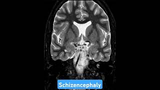 MRI case 79  Schizencephaly mri radiology radiologist neurology neurologist [upl. by Anikes]