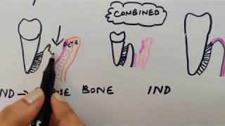 Periodontal flap part 1 carranza chap57 [upl. by Ellennahc]