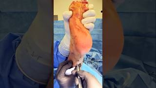 How to lengthen an Achilles Tendon shorts [upl. by Rogerio]