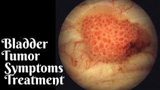 BLADDER TUMOR SYMPTOMS TREATMENT [upl. by Sunderland]