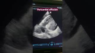 Pericardial effusion 4C view 2 d echo cardiology echocardiography heartdisease [upl. by Lahcar]