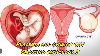 Placenta with umbilical cord and uterus with ovarian cyst specimen grossing😨placenta ovariancyst [upl. by Soane464]